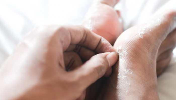What is Skin Peeling and Ways to Avoid it