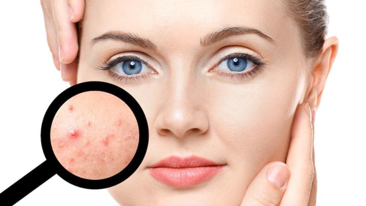 मुहांसों से छुटकारा पाना है, तो आजमाएं ये 5 घरेलू उपाय: Home Remedies For Acne